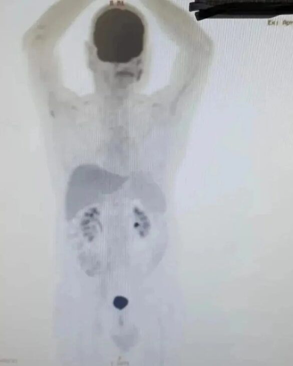 Hombre vence al cáncer tras terapia de células FOTOS