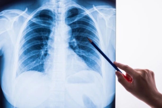 ¿Qué es una trombosis pulmonar?