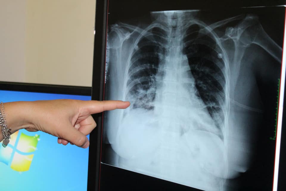 Ómicron en México. Detectan primer caso sospechoso 