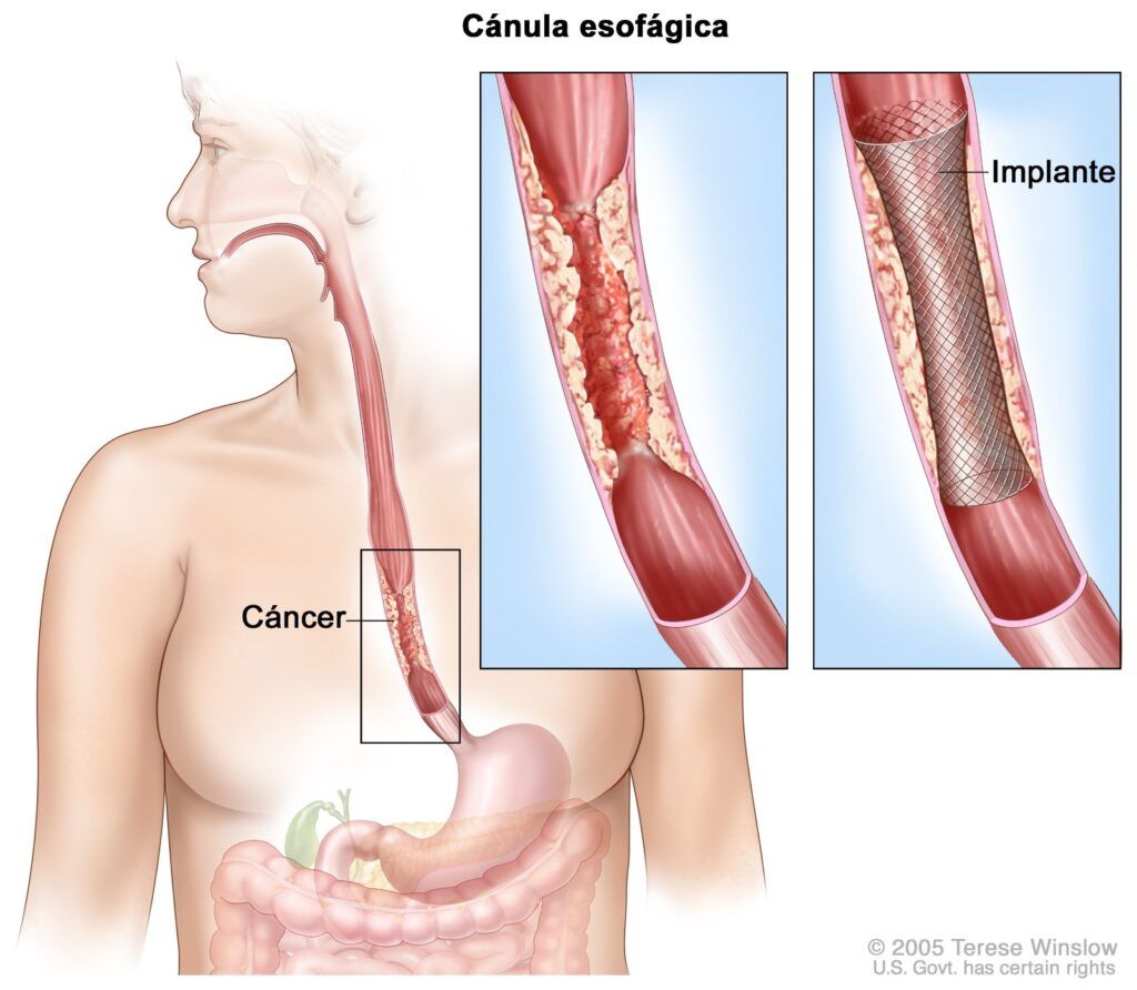 ¿Qué es el cáncer de esófago?