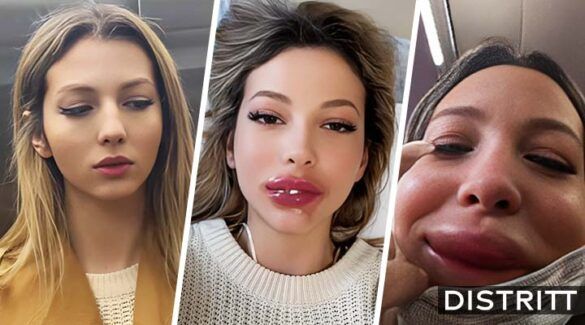 Joven se inyecta los labios en estética y sale mal