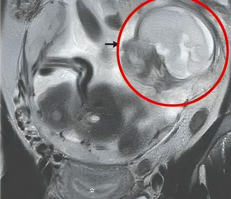 Mujer descubre embarazo en su intestino