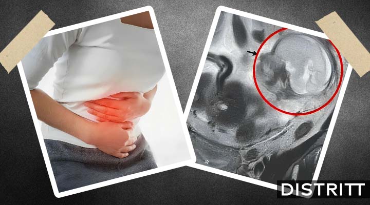 Mujer descubre que tiene un bebé creciendo en intestino