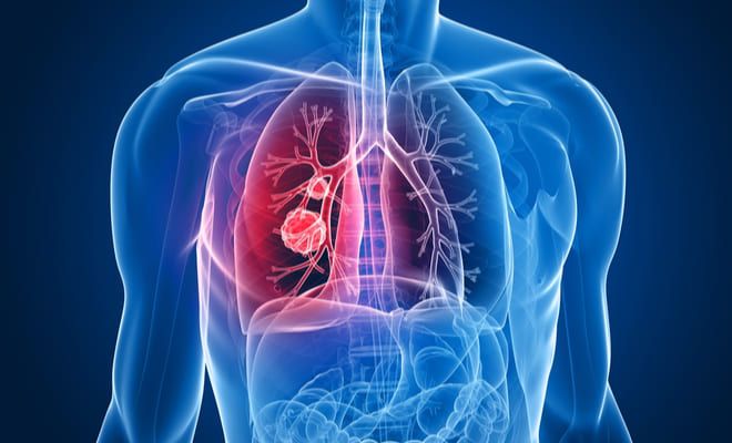 qué es una trombosis pulmonar