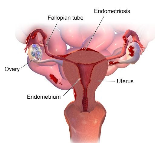 Síntomas de la endometriosis
