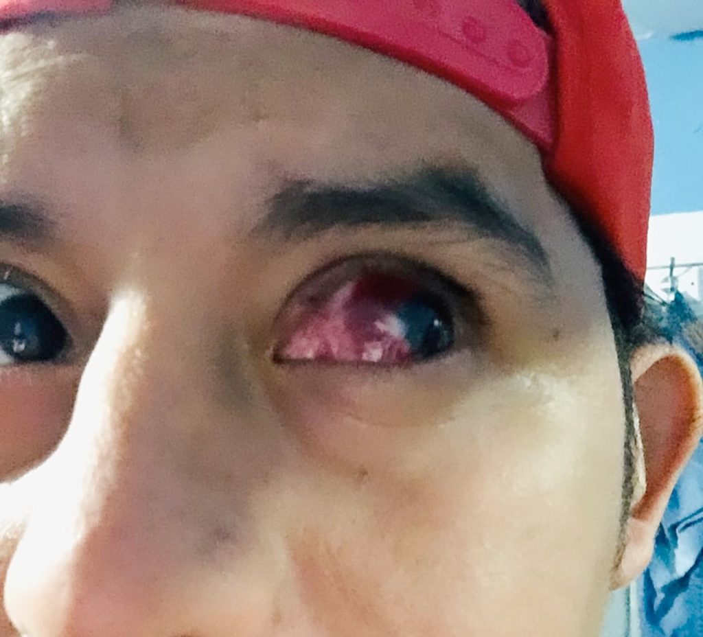 hombre perderá ojo por ver eclipse sin protección