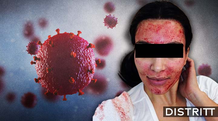 Mujeres contraen VIH tras tratamiento facial vampiro