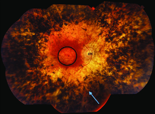 ¿Qué es la retinitis pigmentosa?