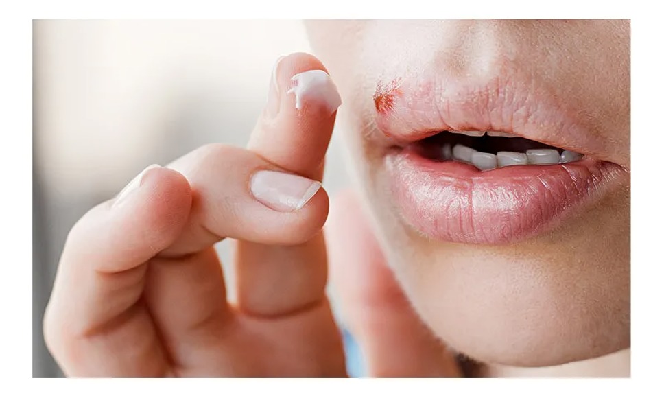Niño habría recibido beso de persona infectada con herpes