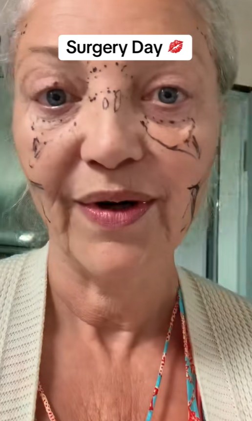 Abuelita se somete a cirugía estética