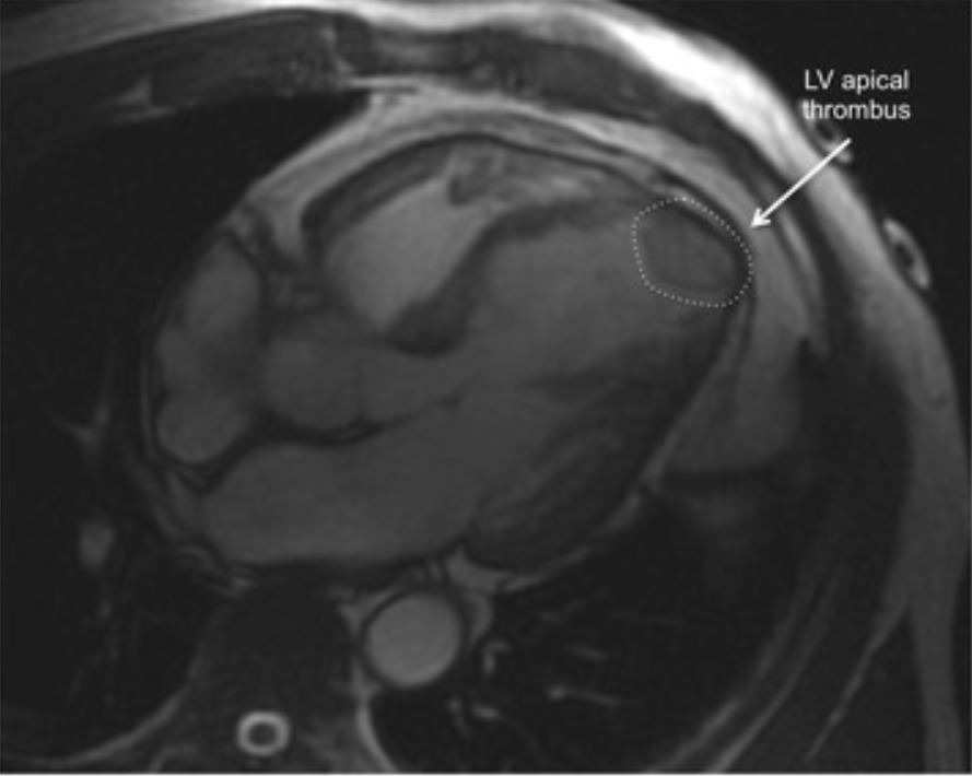 ¿Qué es la miocardiopatía de Takotsubo?