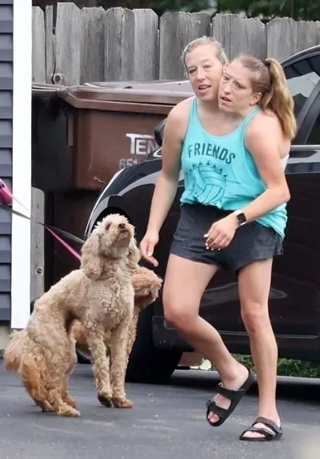 ¿Qué pasó con las siamesas Abby y Brittany Hensel?
