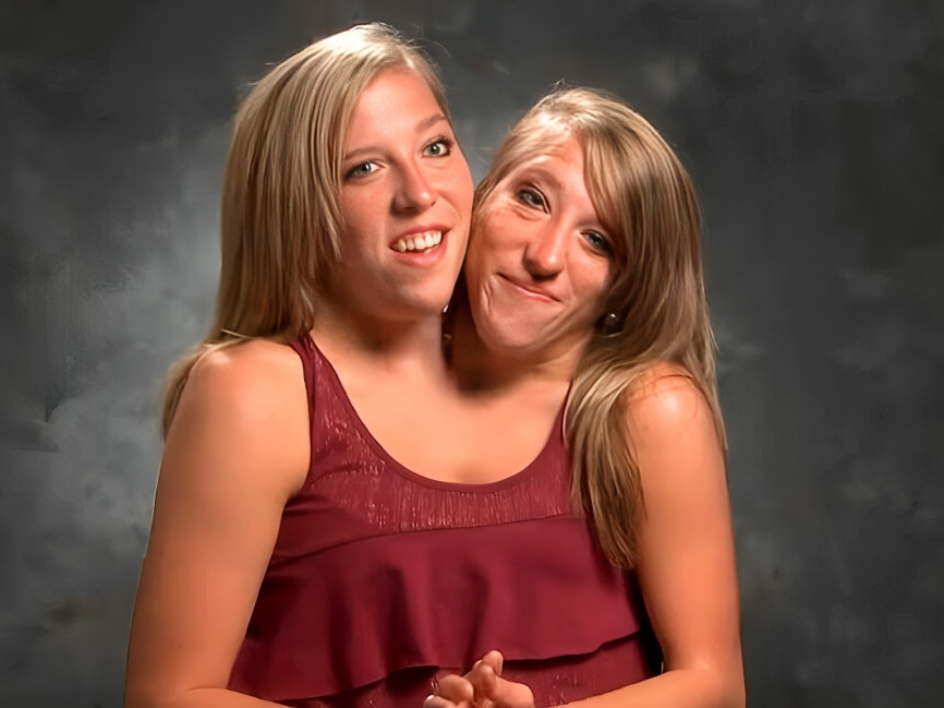 ¿Qué pasó con las siamesas Abby y Brittany Hensel?