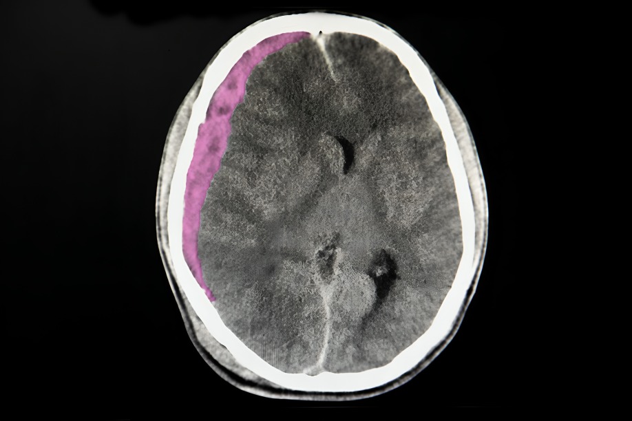 ¿Qué es un hematoma subdural?