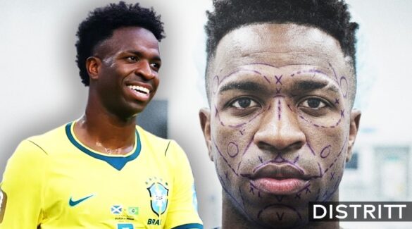 Nueva apariencia de Vinicius Jr con cirugía facil |VIDEO